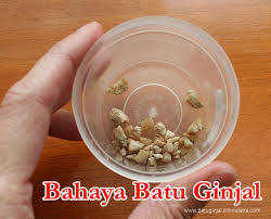 Illustration for article titled Penyebab Terkena Penyakit Batu Ginjal